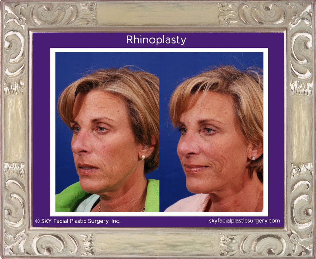 Rhinoplasty - San Diego