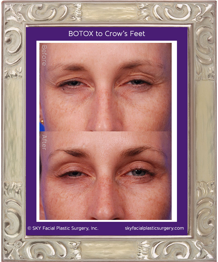 Botox for Crow's Feet