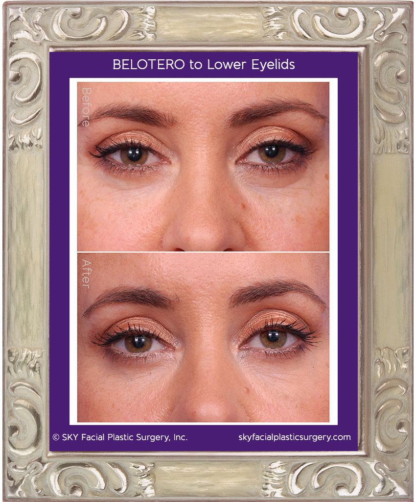 Belotera for rejuvenation of the lower eyelid