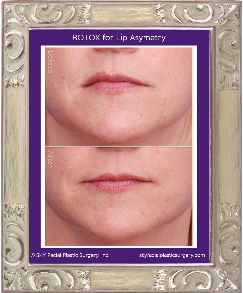 Botox for lip asymmetry