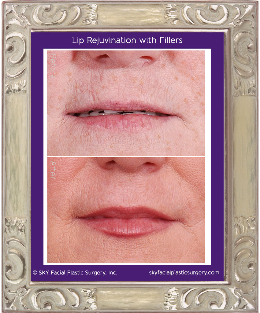 Lip Rejuvination with Fillers