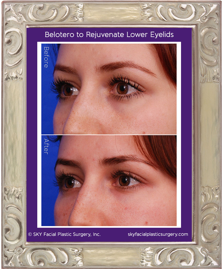 Belotero Balance for lower lid rejuvenation