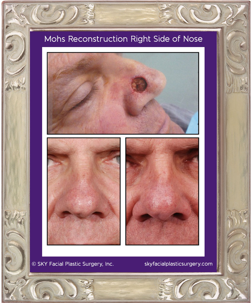 Mohs Reconstruction in San Diego after Skin Cancer — SKY Facial Plastic  Surgery