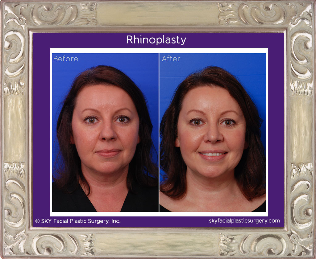 Cosmetic rhinoplasty - Frontal Comparison