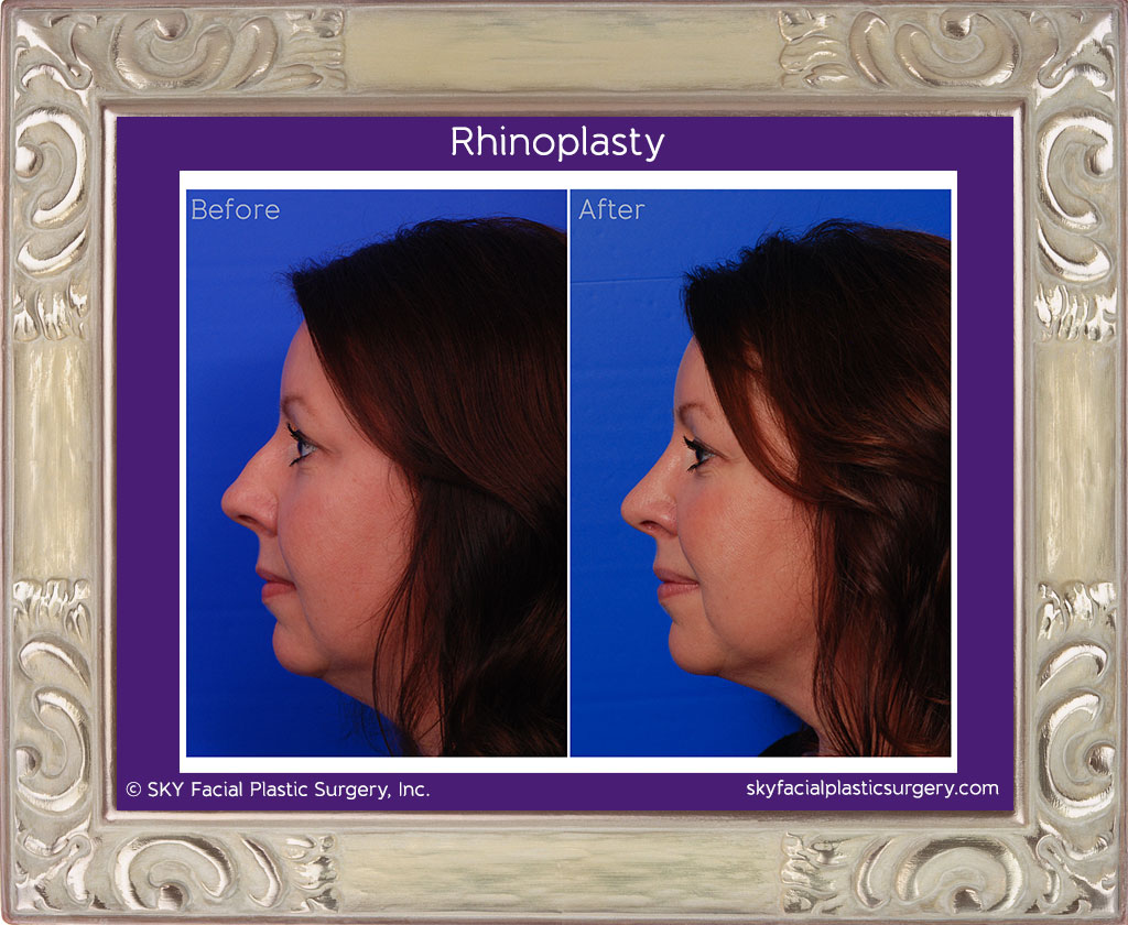 cosmetic rhinoplasty - Left Lateral Comparison - San Diego