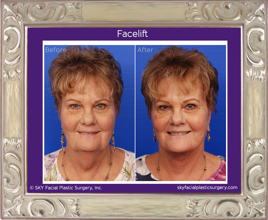 Lower face and neck lift