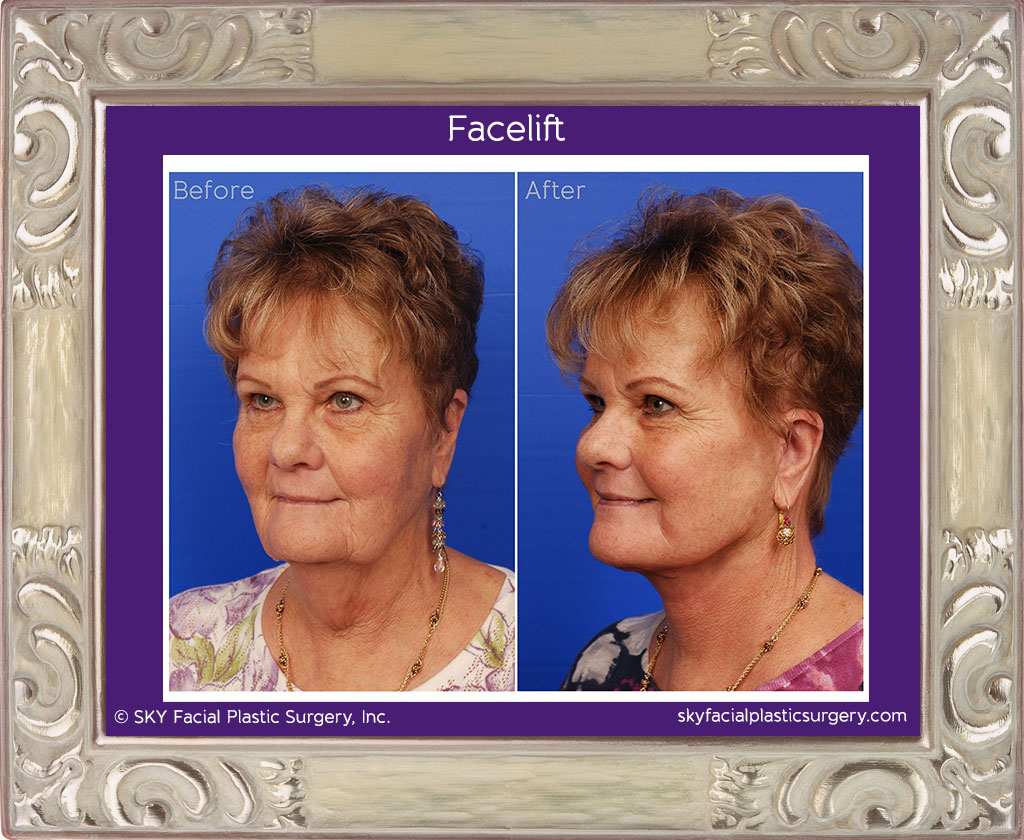 Lower face and neck lift