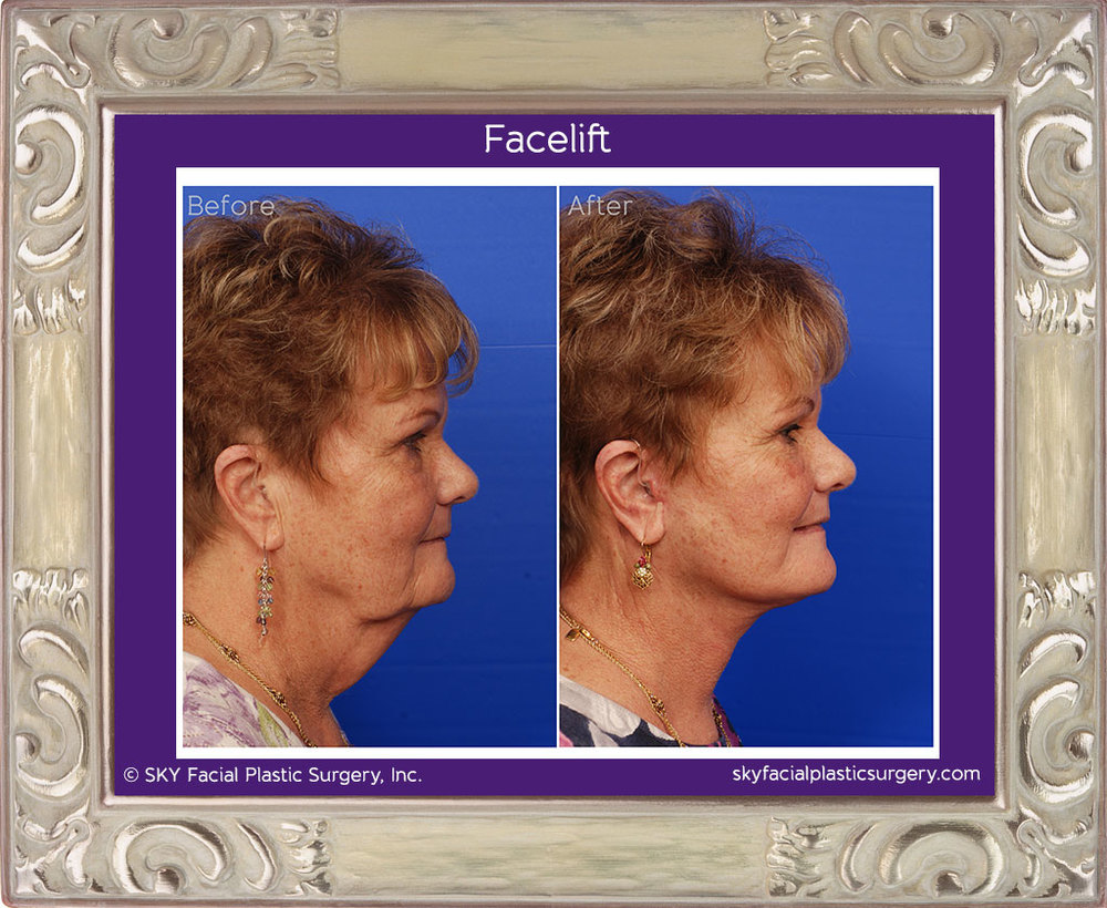 Facelift Before & After Photos: What a Facelift Looks Like at 40, 50, 60 &  70, Facelift in San Diego, CA