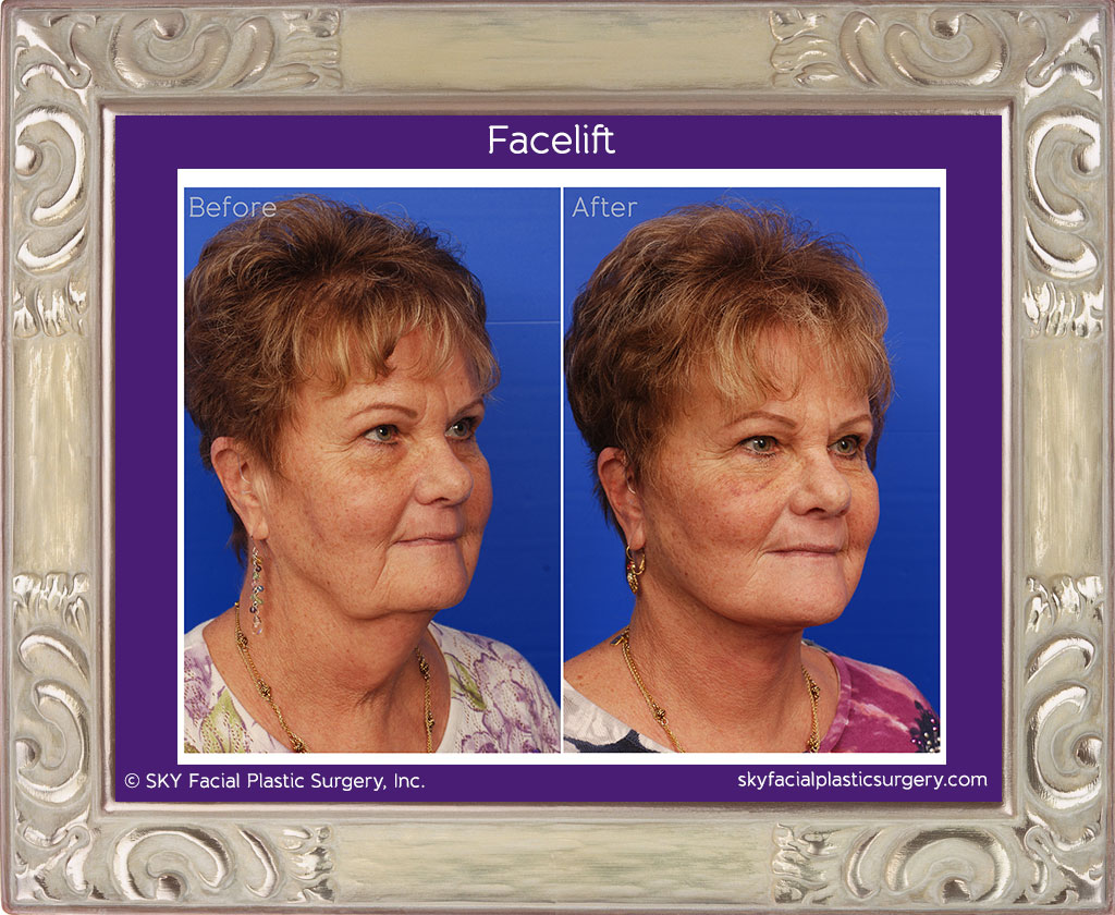 Lower face and neck lift