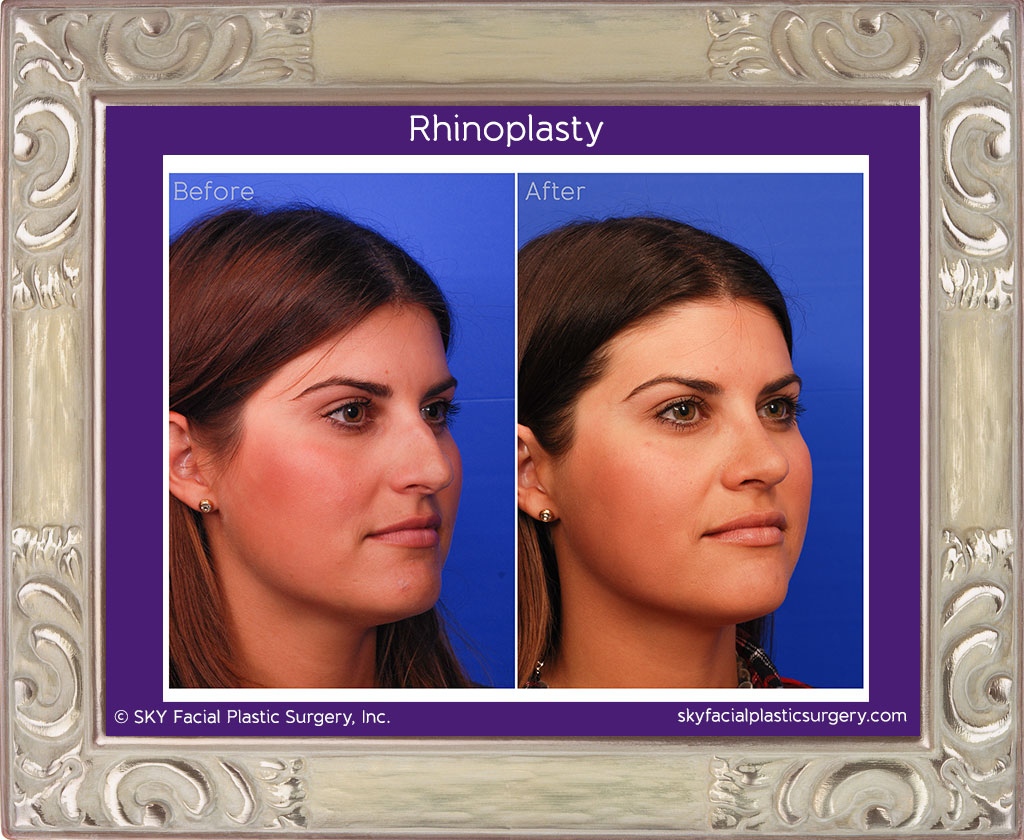 Copy of Rhinoplasty - San Diego