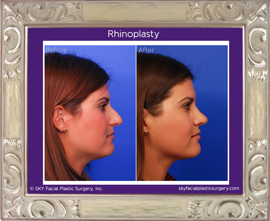 Copy of Rhinoplasty - San Diego