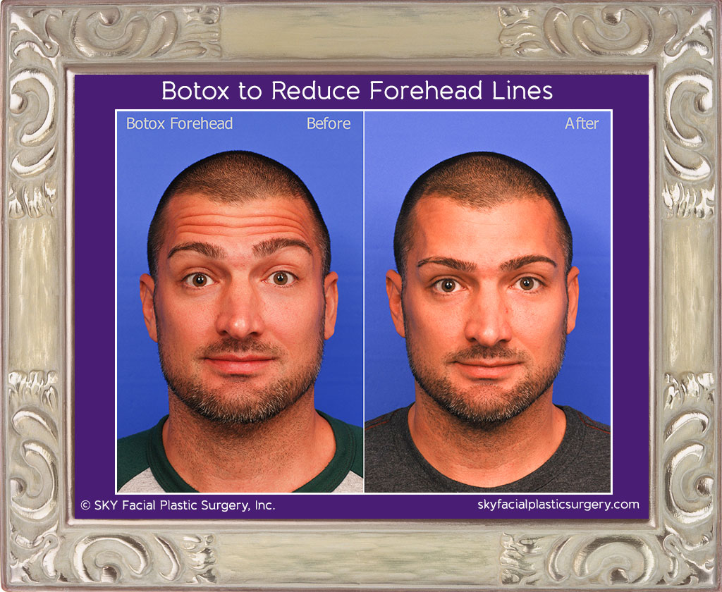 Botox to reduce forehead lines