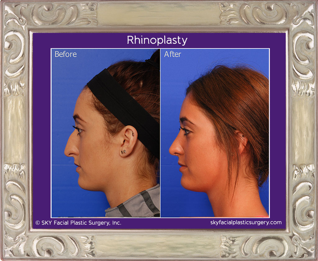 Rhinoplasty - San Diego