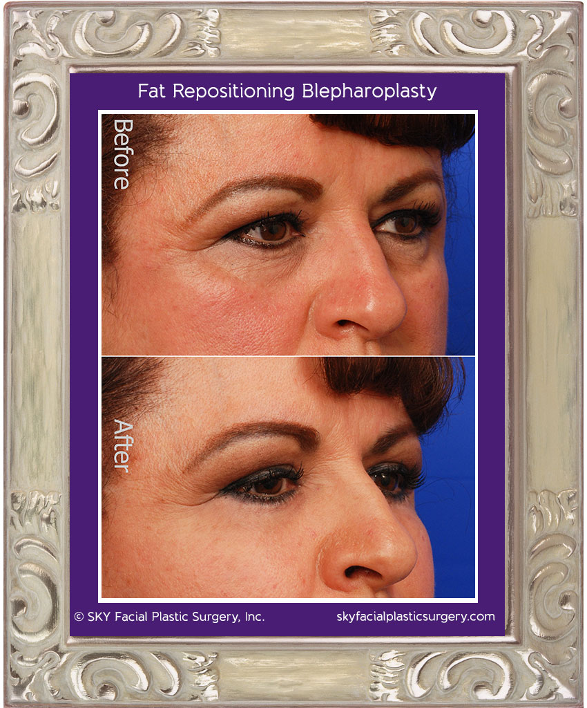 Upper and lower blepharoplasty