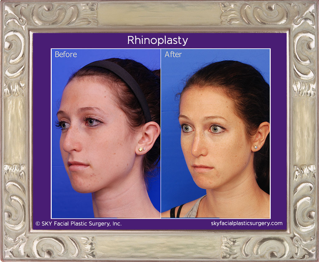 Rhinoplasty - San Diego