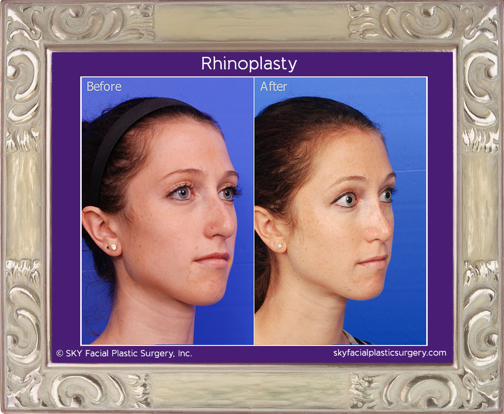 Rhinoplasty - San Diego