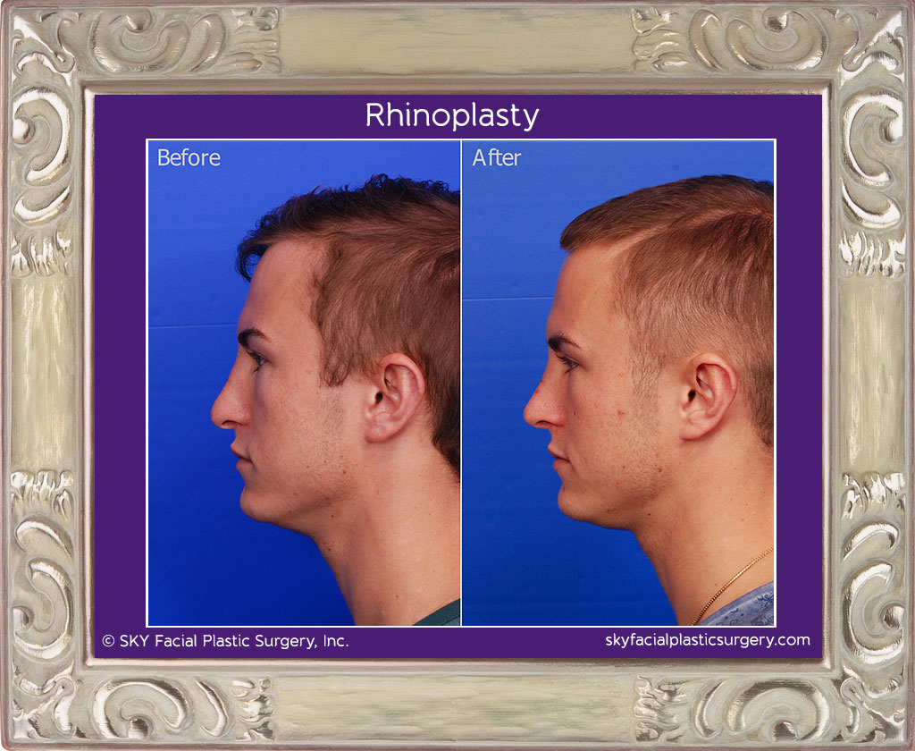 Male rib rhinoplasty - Left Lateral View