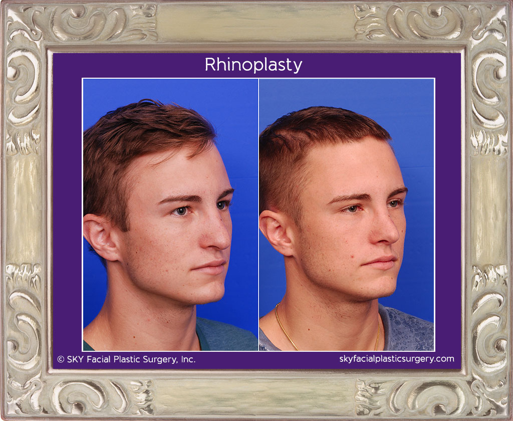 Male Rib Rhinoplasty - Left Oblique View