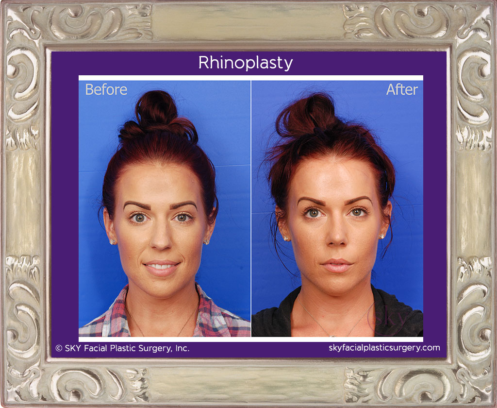 Female cosmetic rhinoplasty (nose job)