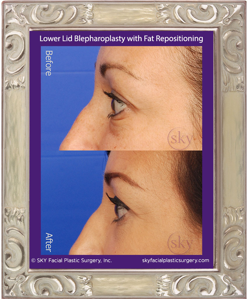 Lower lid blepharoplasty with fat repositioning