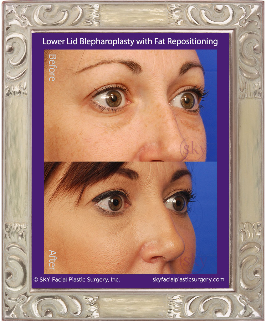 Lower lid blepharoplasty with fat repositioning