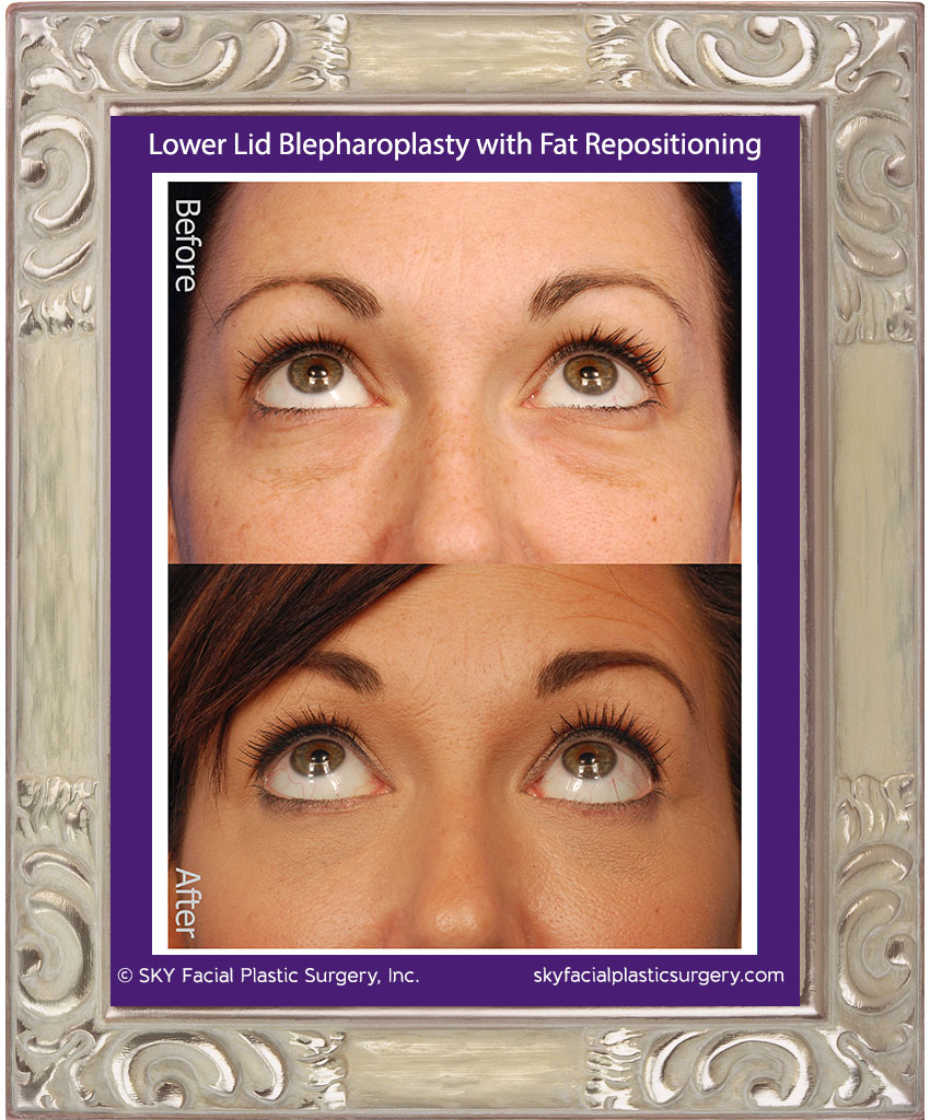 Lower lid blepharoplasty with fat repositioning