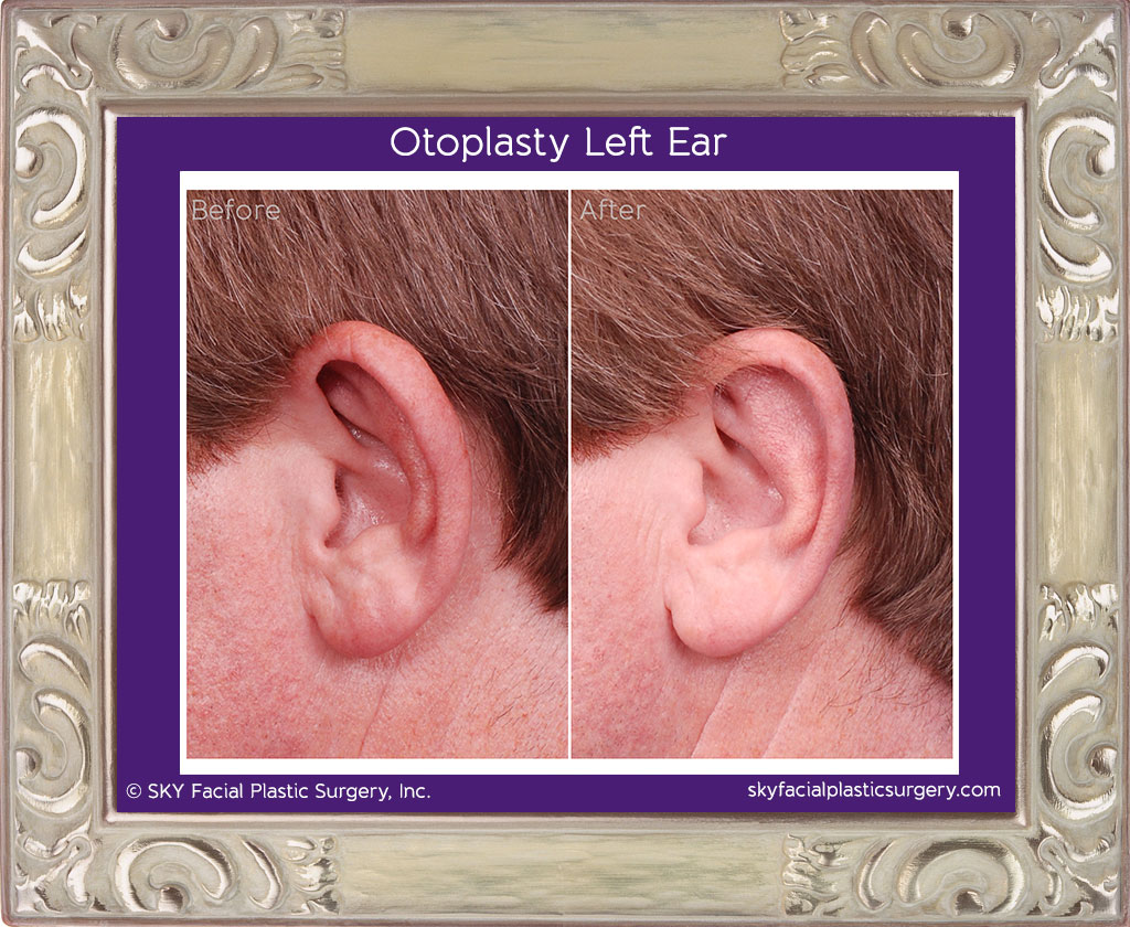 Otoplasty in San Diego - Ear Reshaping