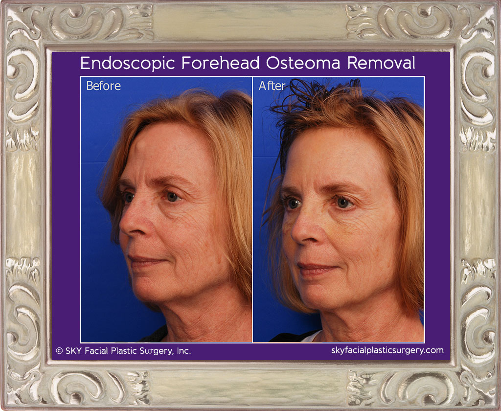 Endoscopic Forehead Osteoma Removal