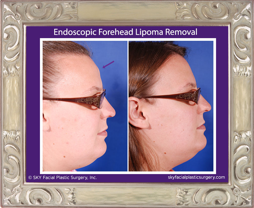 Endoscopic Forehead Lipoma Removal