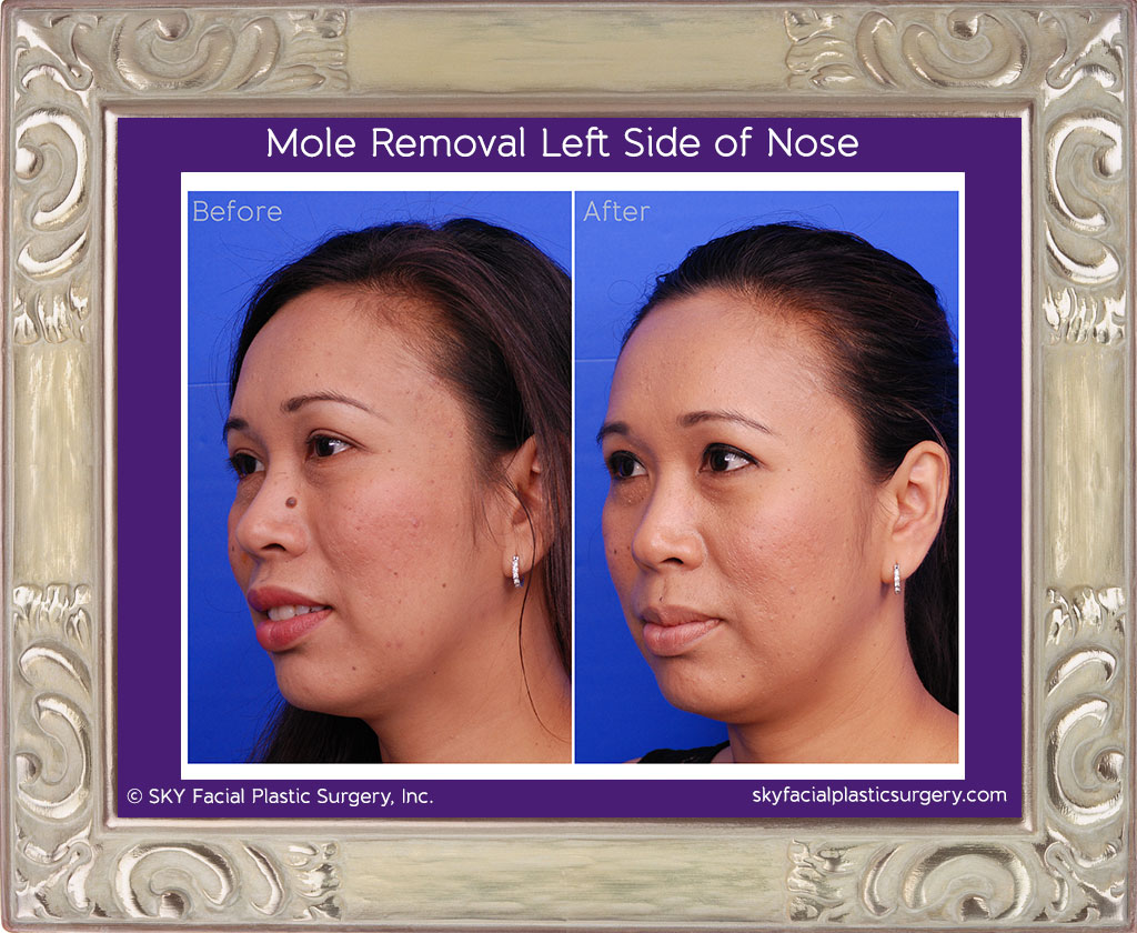 Mole removal - San Diego