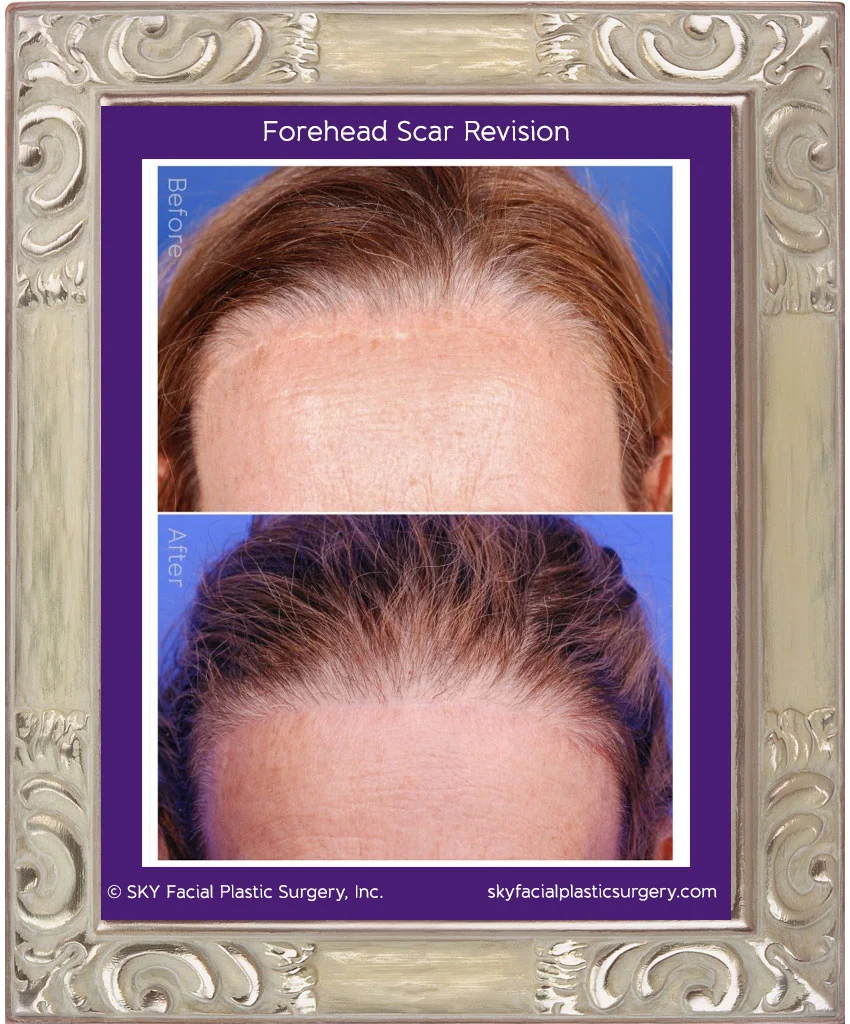 Scar Revision San Diego — SKY Facial Plastic Surgery
