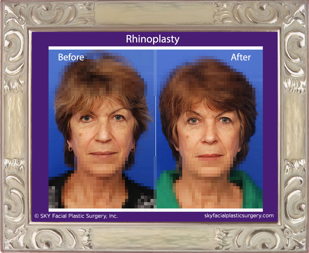 Rhinoplasty