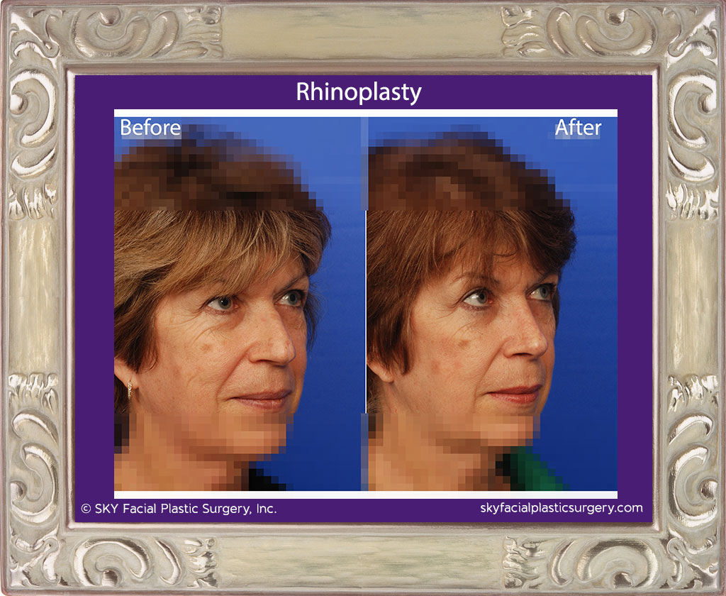 Rhinoplasty