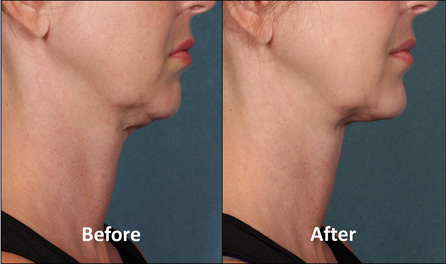 Results after Kybella treatment. 