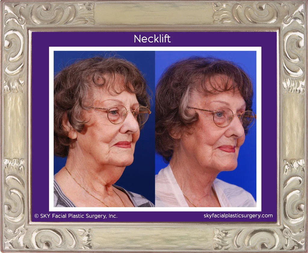 Necklift: Before & After photos.