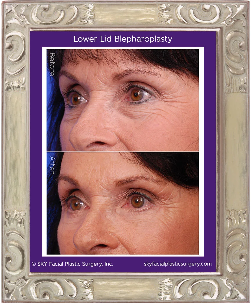 Before & After photos of lower-lid blepharoplasty patient.