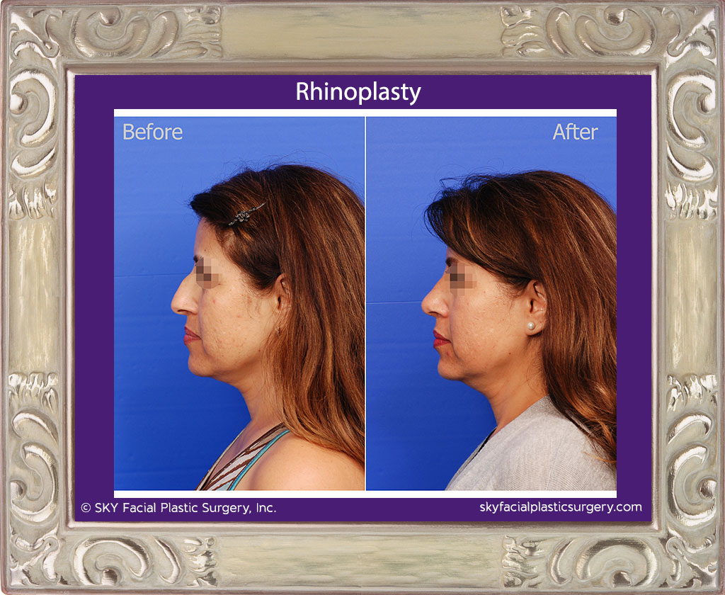 Left Lateral View Rhinoplasty
