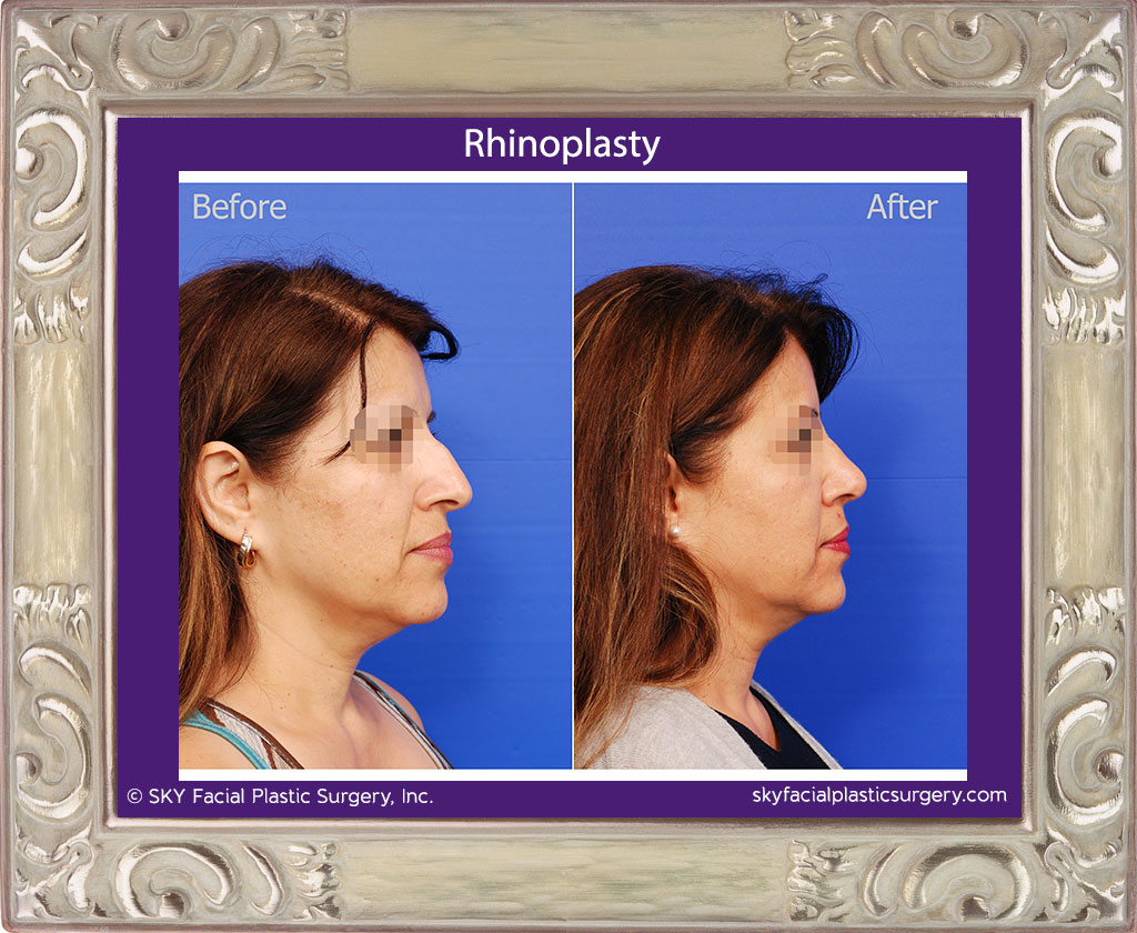 Right Lateral View Rhinoplasty