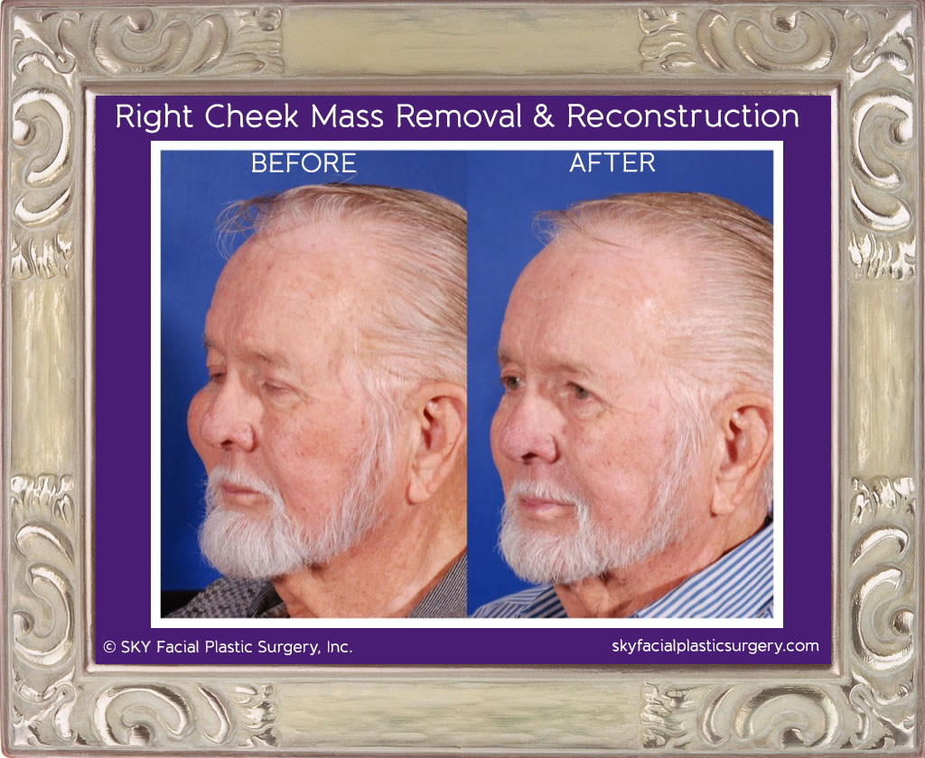 Right Cheek Mass Removal