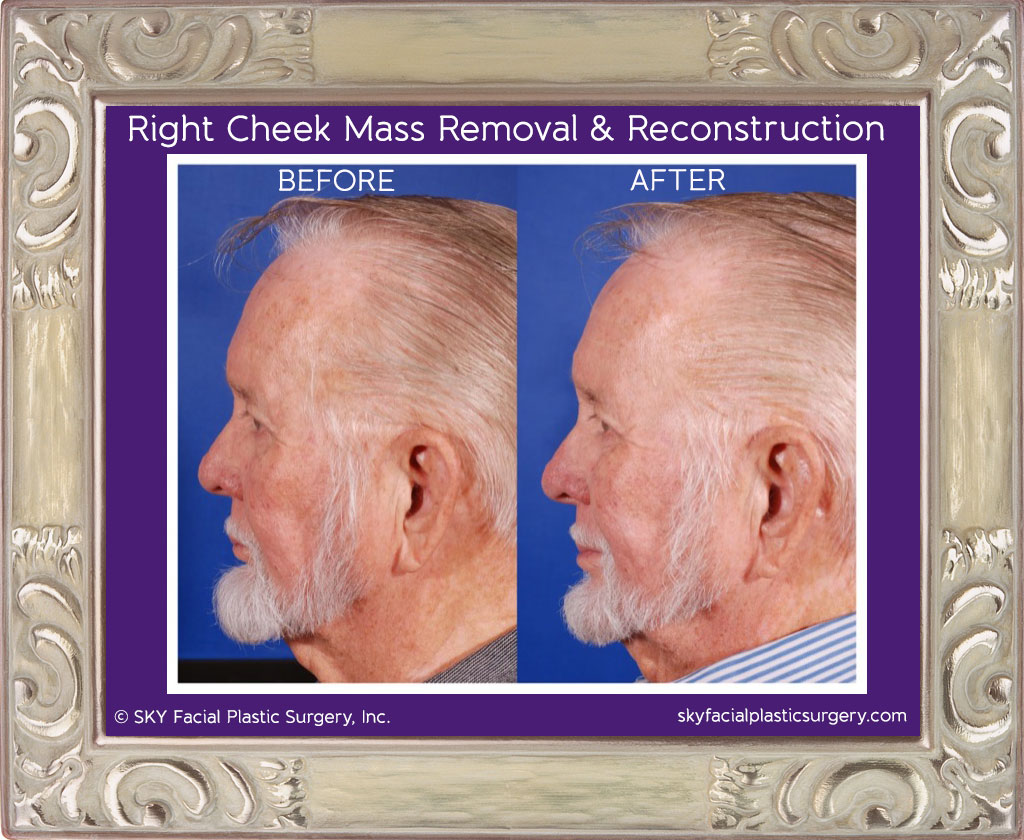 Right Cheek Mass Removal