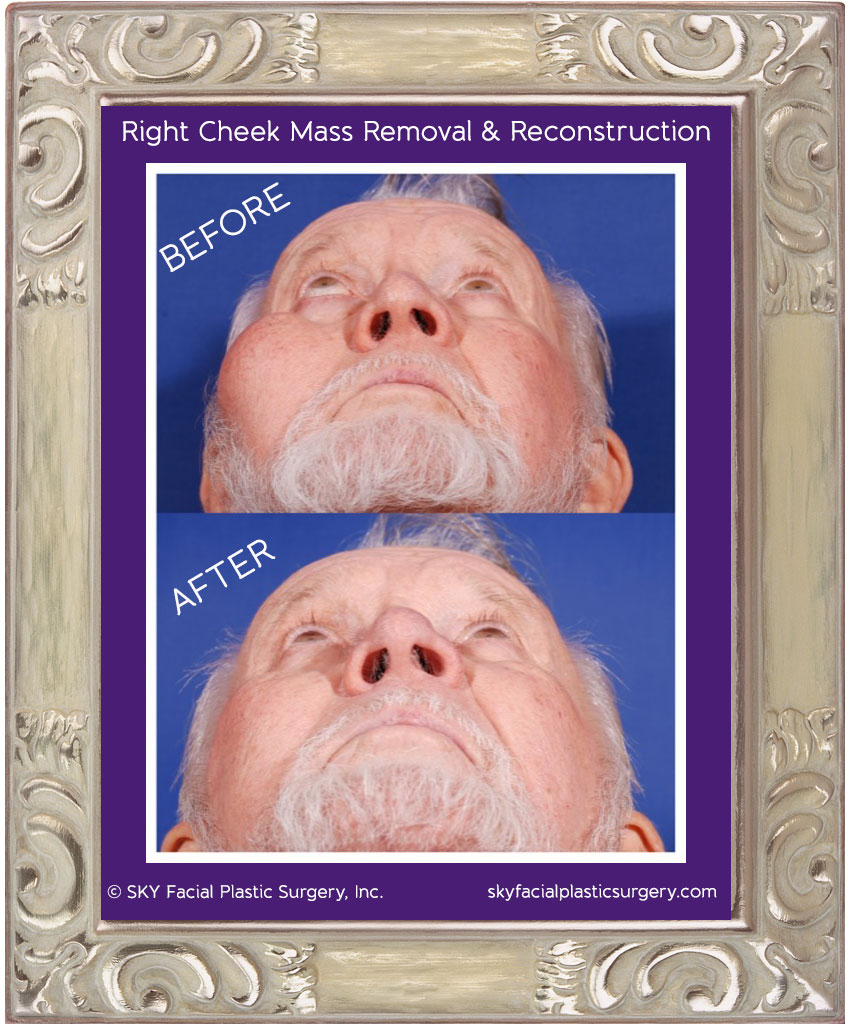 Right cheek mass removal