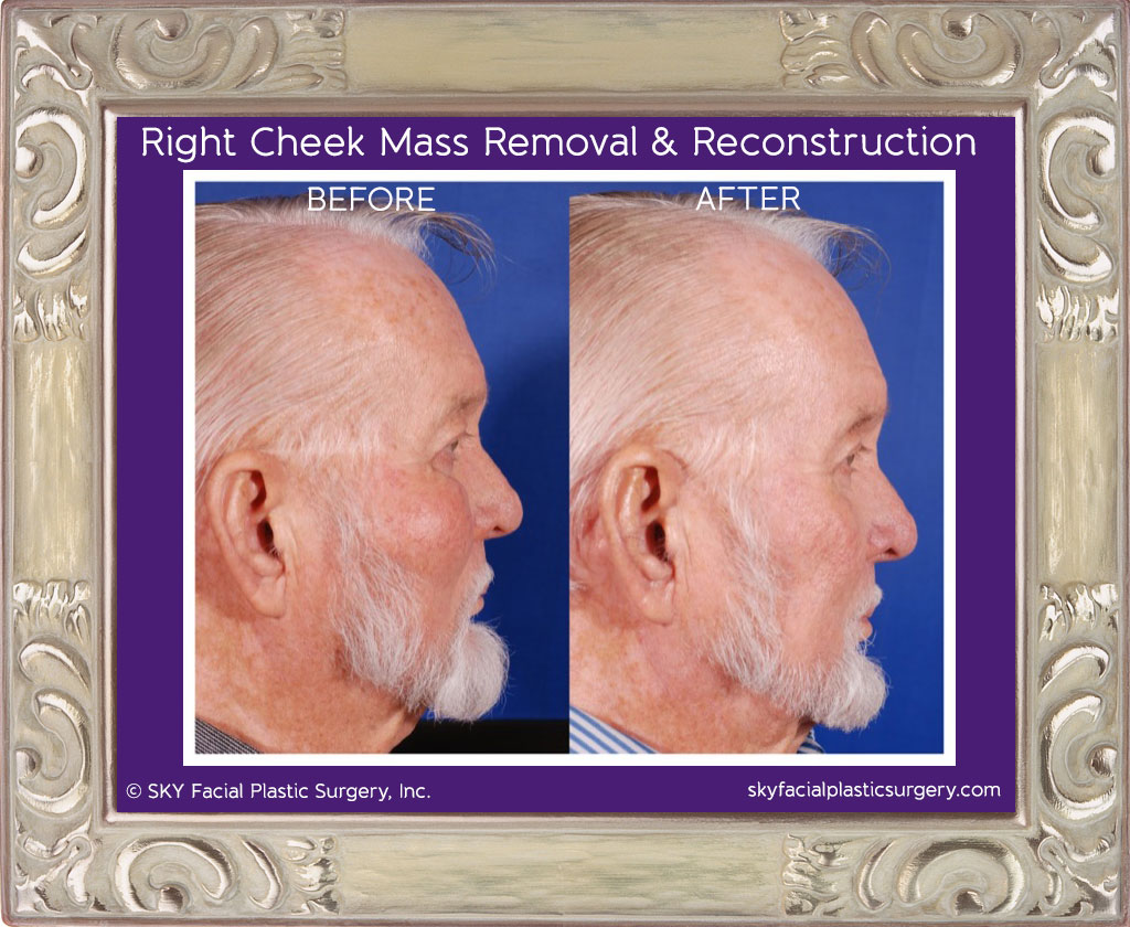 Right cheek mass removal