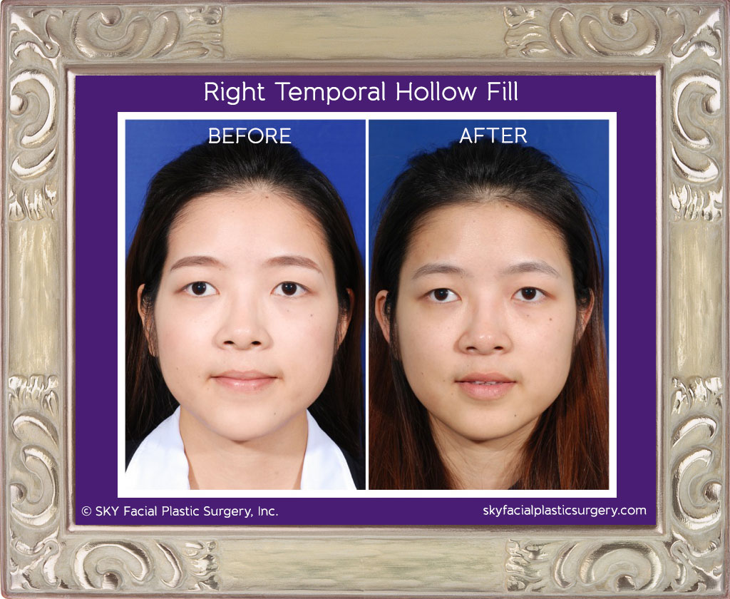 Permanent correction of temporal hollowing