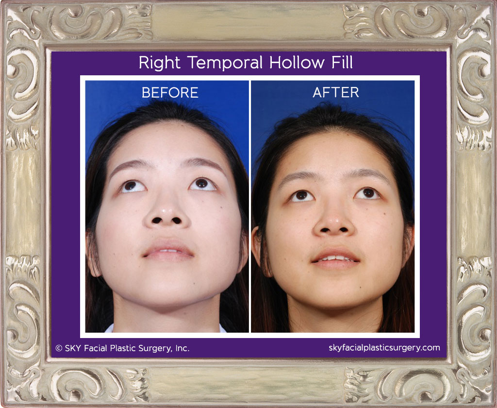 Permanent correction of temporal hollowing