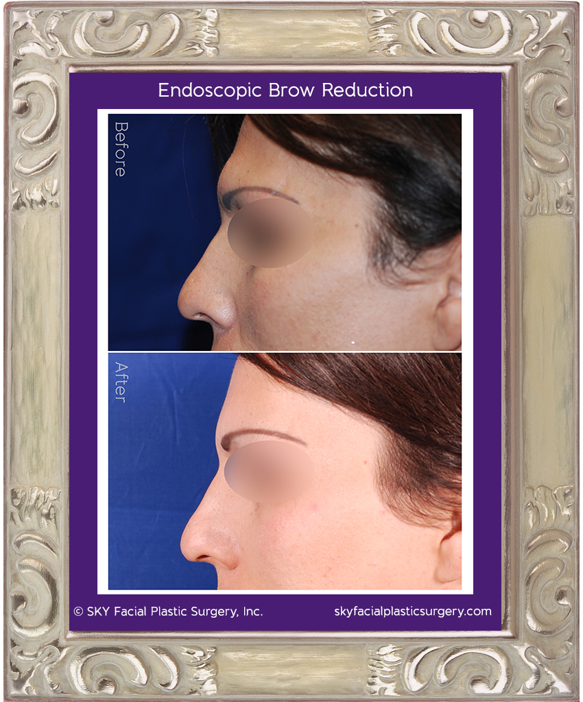 Forehead reduction was performed to provide a more feminine profile. Small incisions were hidden behind the hairline.