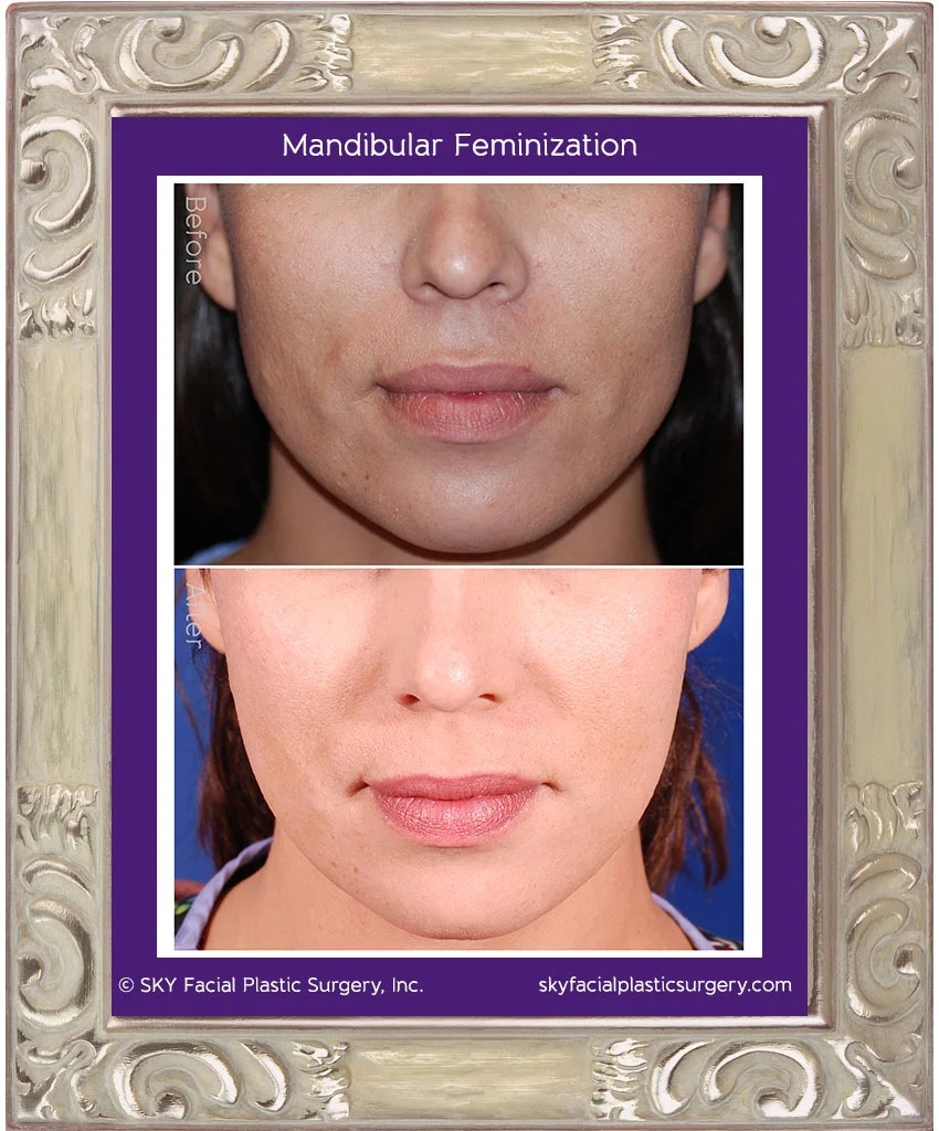 Facial Contouring and Implants San Diego — SKY Facial Plastic Surgery