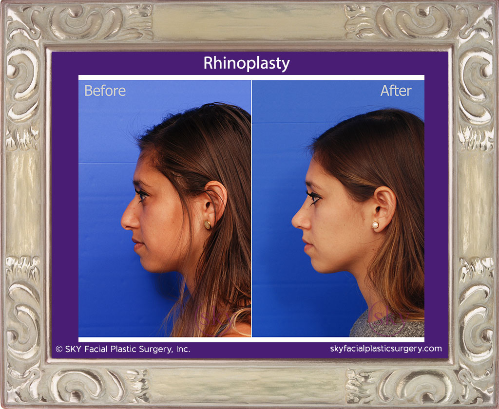 Rhinoplasty