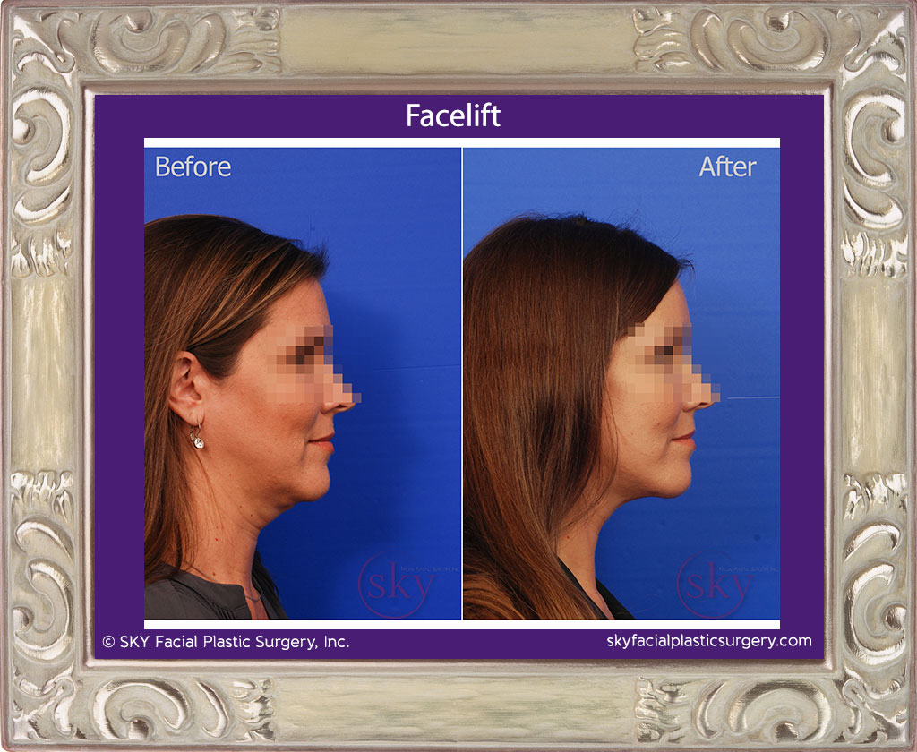 Facelift