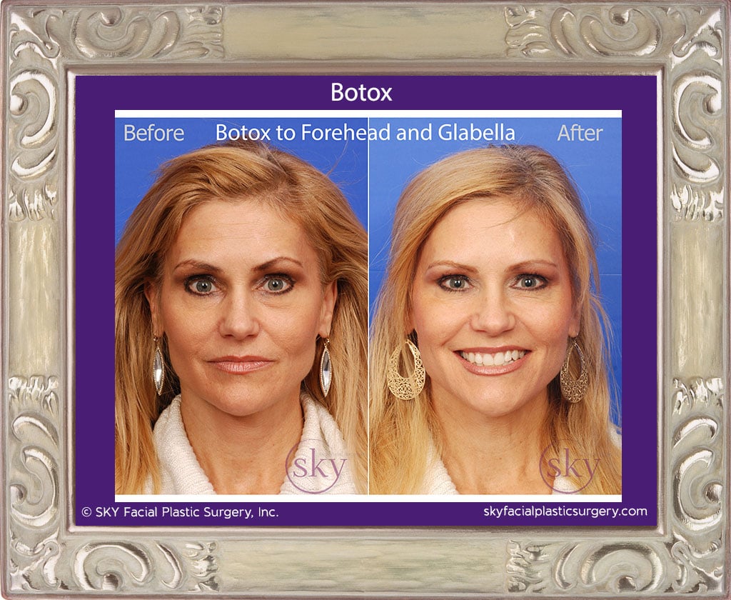 Botox to forehead and glabella