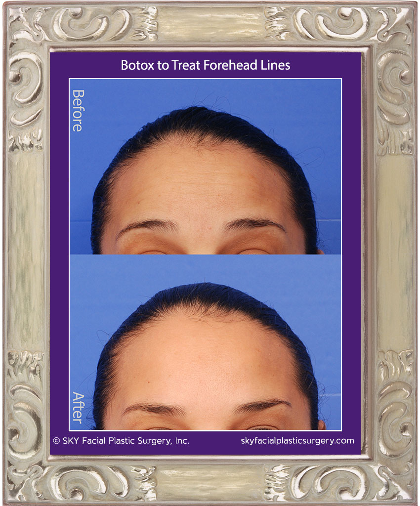 Botox to treat forehead lines